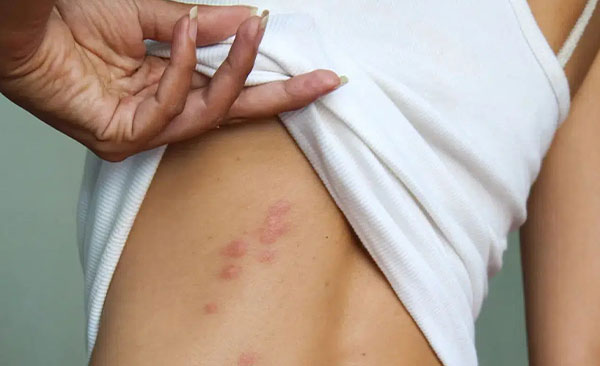 piqûres-de-punaises-de-lit-symptômes